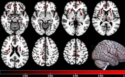 a series of black and white images of sections of a brain with red patches